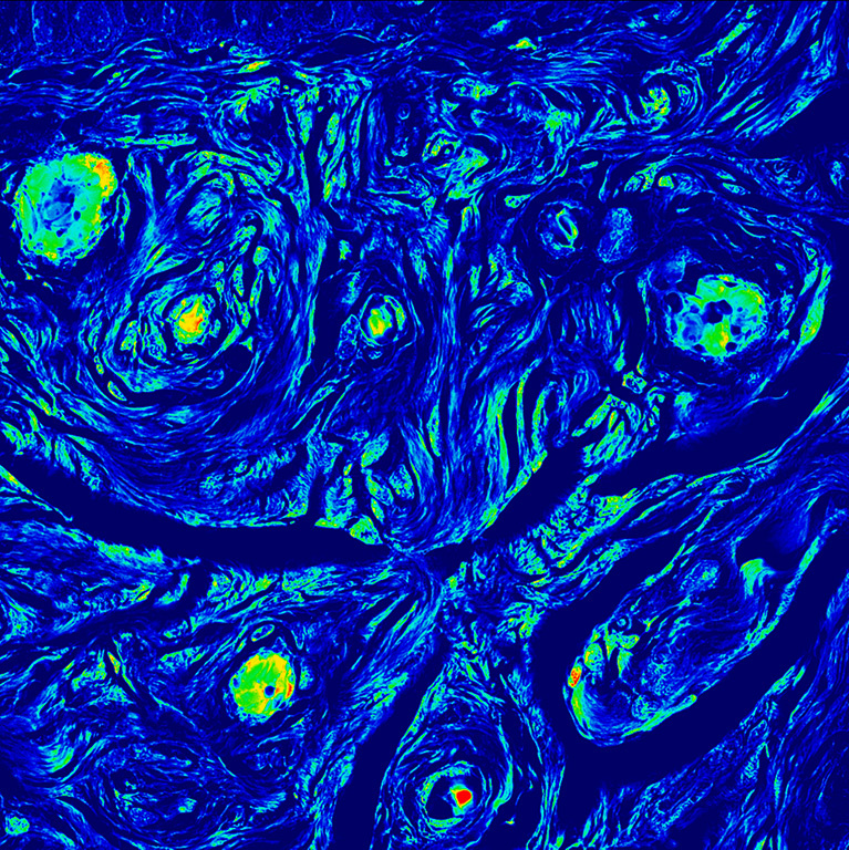 Fallopian tube tissue that is colored very similar the Van Gogh's Starry Night