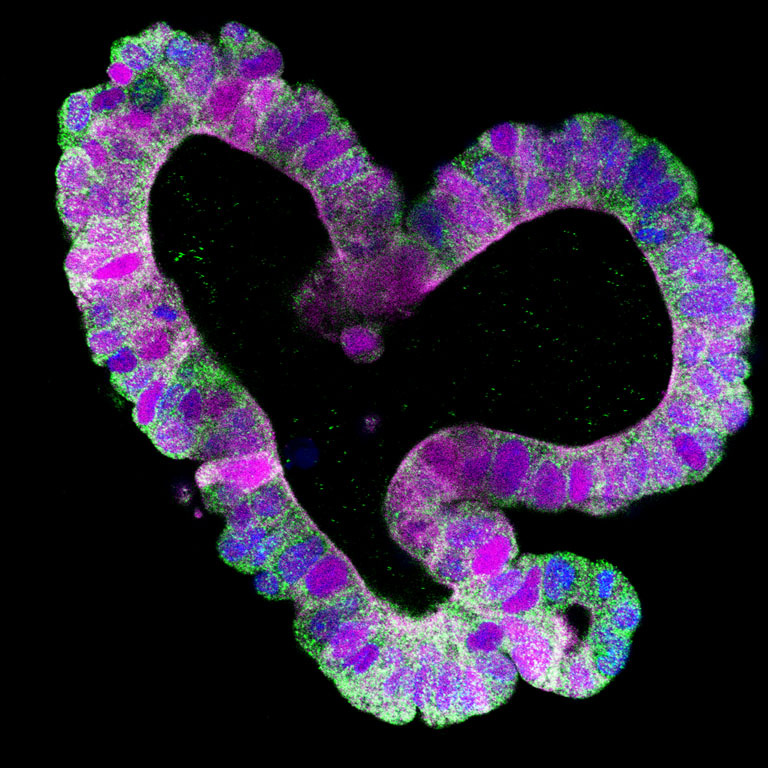 A purple and green heart made of tumor organoid, amongst a black background