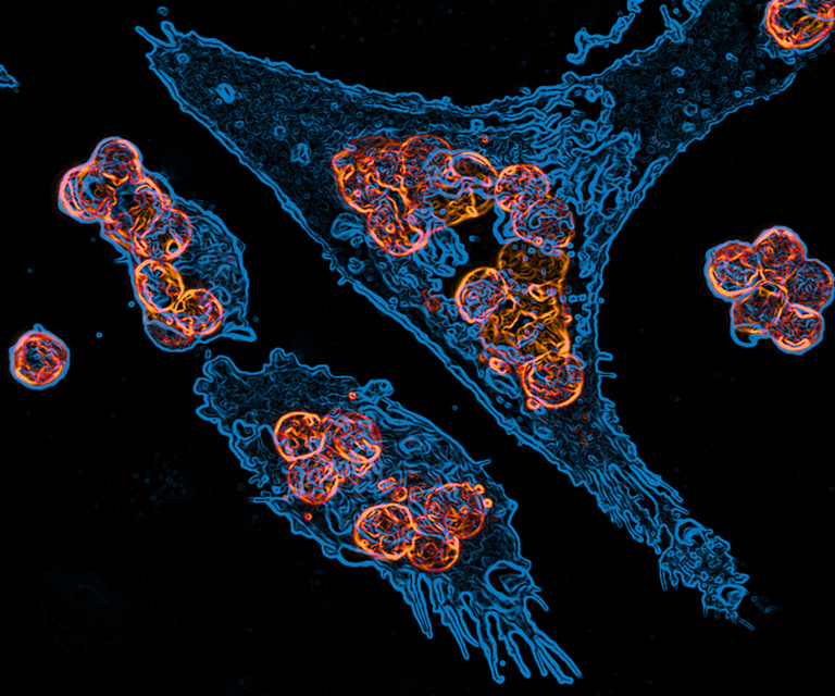 blue macrophages with orange cancer cells
