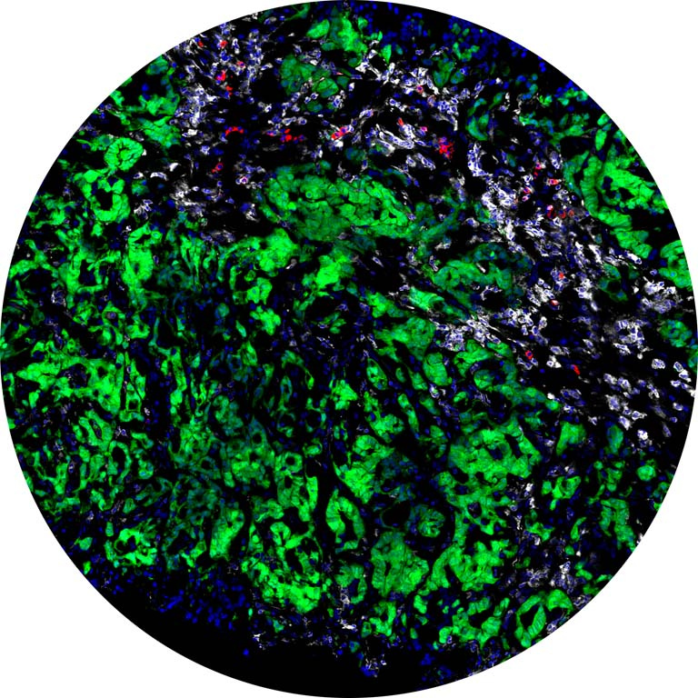 immune cells in a tumor