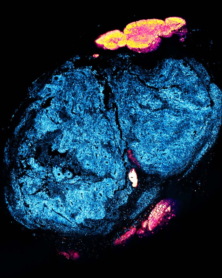 fluorescent blue molecules shine in a tumor