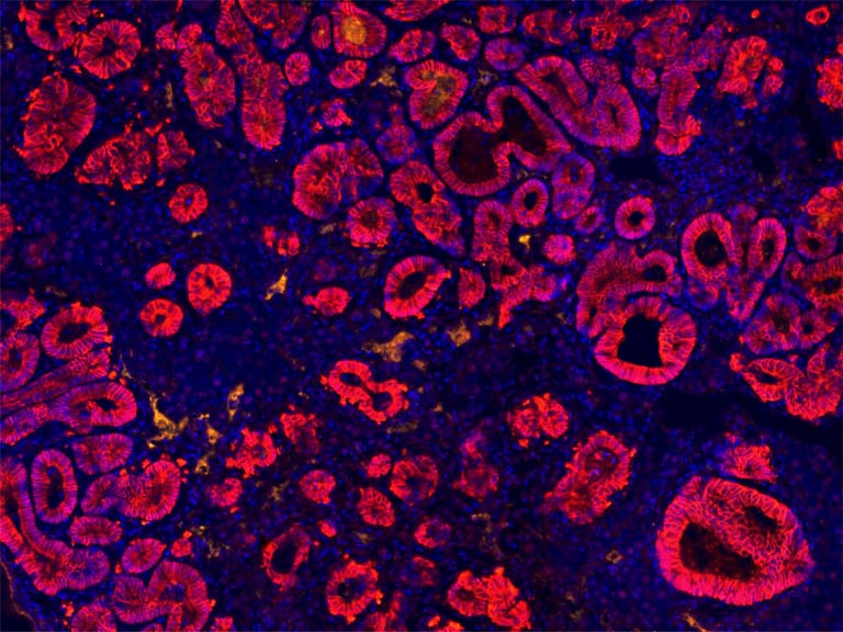 rosy red rings of intestinal cancer cells interspersed with blue cells on a black background