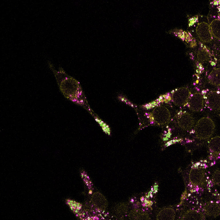 A cell featuring green endosomes and pink mRNA, depicting the mRNA's successful escape to the cytosol for cancer treatment.