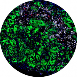 immune cells in a tumor