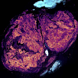 magenta molecules fluoresce in a tumor