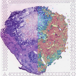 a multi-colored slice of tumor tissue in a square made of dotted patterns that also overlay the right half of the sample